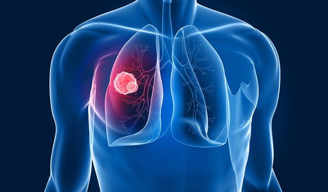 Göğüs Hast. Uzm. Dr. Tekeli: Kısa süreli kontroller akciğer kanserini erken teşhis ettiriyor