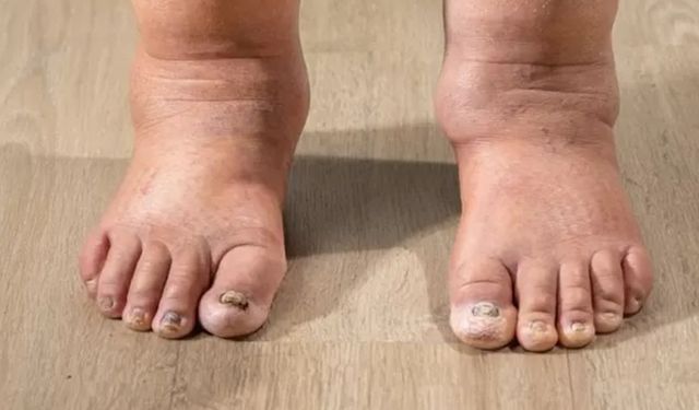 Kollarınızda veya bacaklarınızda şişlik varsa nedeni lenfödem olabilir!