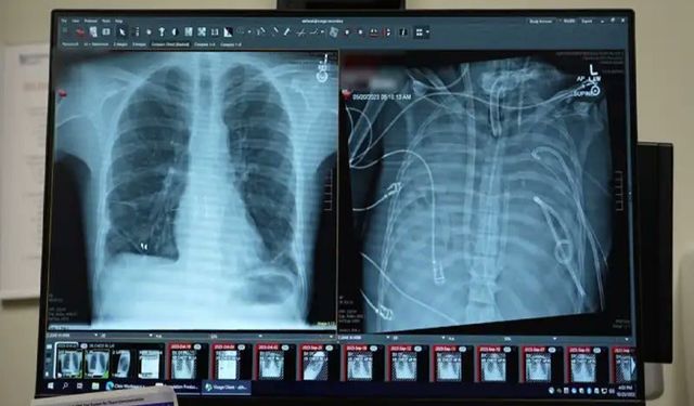 Yapay akciğer nakle kadar hastayı hayatta tuttu